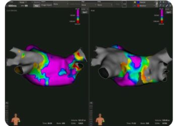 Tunisie: première réussite d’ablations cardiaques complexes à l’hôpital Sahloul